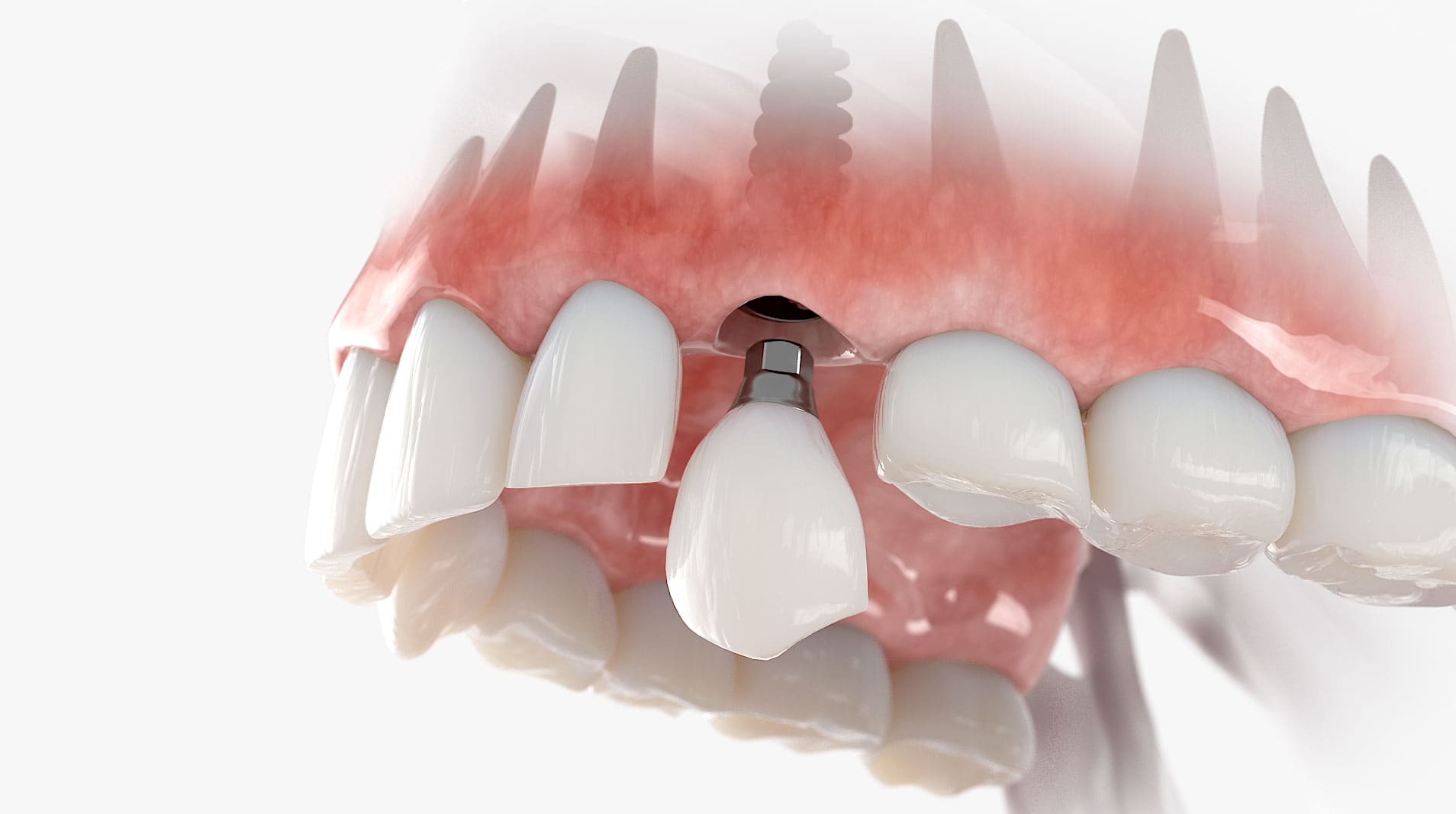 Implant dentaire de nouvelle génération en 3D