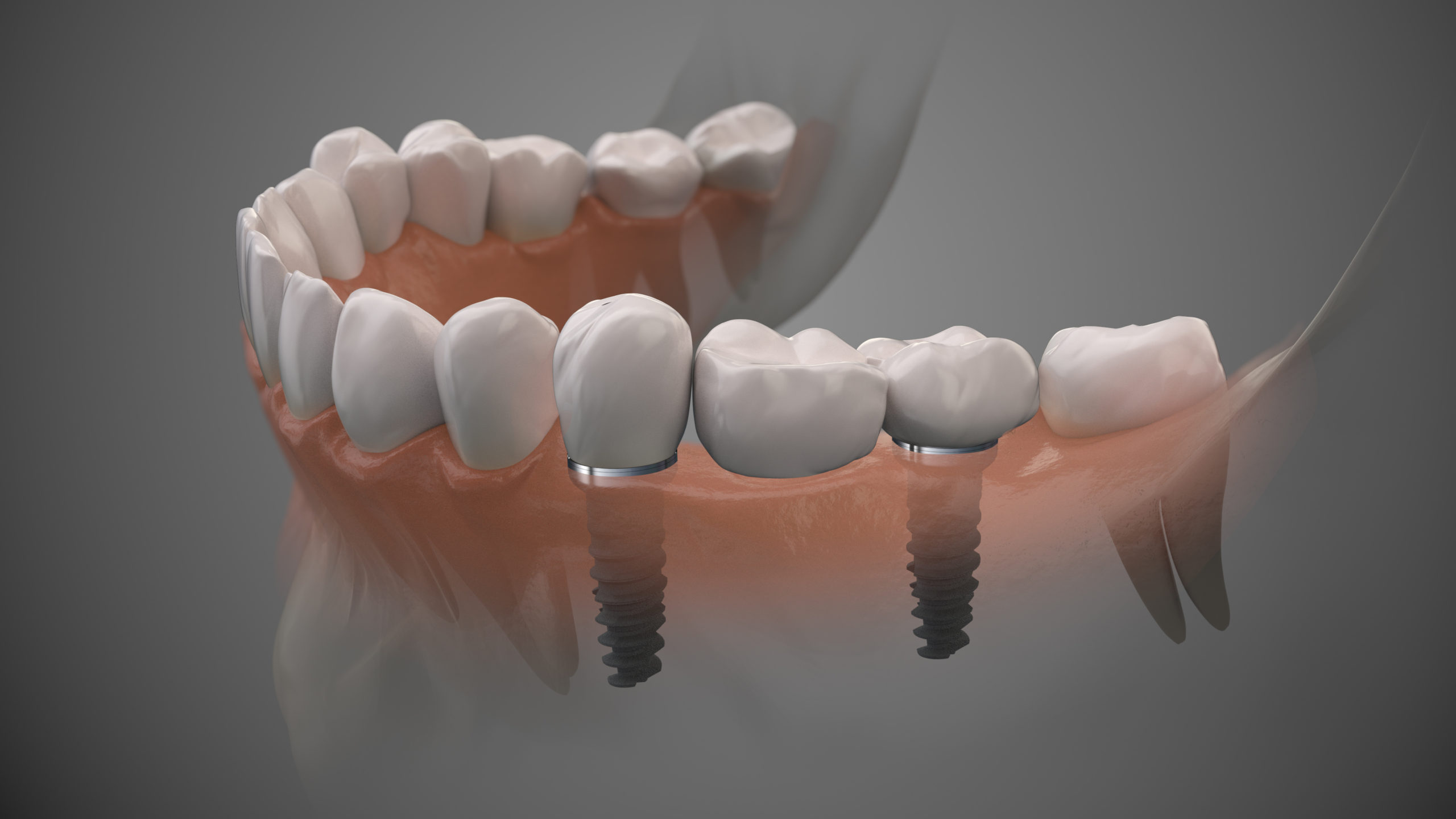 Remplacer plusieurs dents manquantes avec plusieurs implants