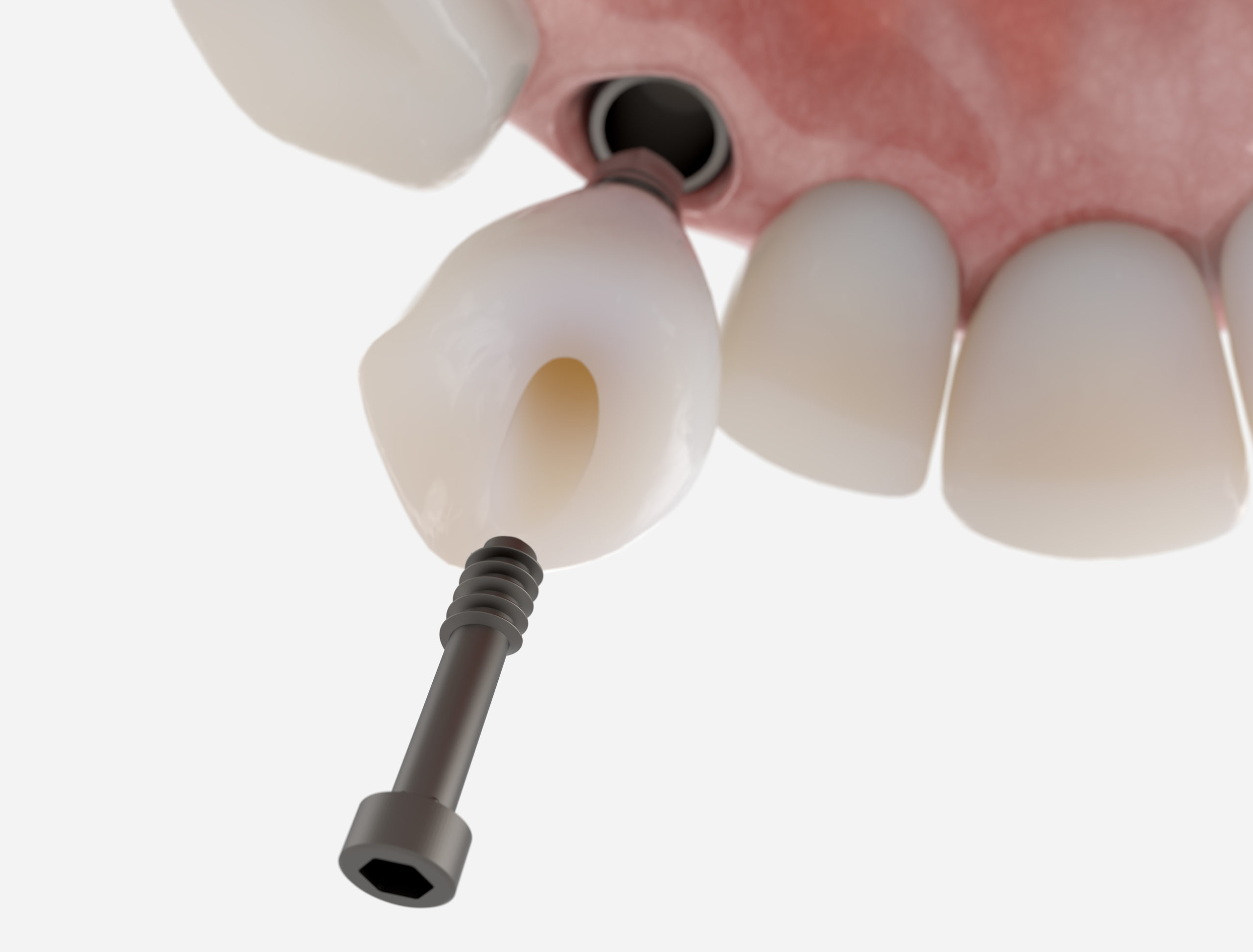 Une prothèse en céramique vissée sur un implant dentaire pour remplacer une canine, dent du sourire